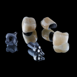 Indirect Implants - PFM crowns