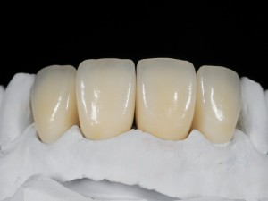 How to Choose the Best Zirconia Crown Lab for Your Practice